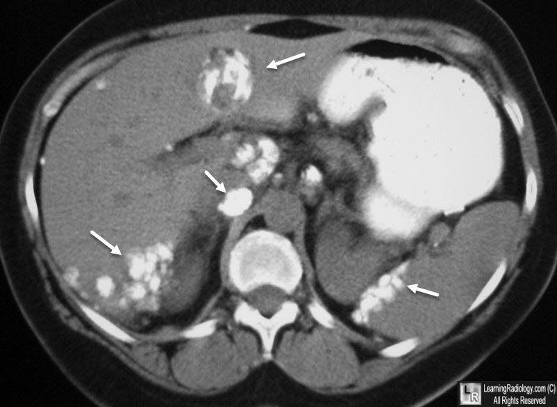 Ovarian Carcinoma Metastases.